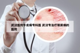 武漢醫(yī)院牛皮癬?？漆t(yī) 武漢專治療銀屑病的醫(yī)院