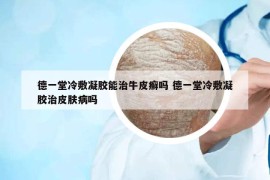 德一堂冷敷凝膠能治牛皮癬嗎 德一堂冷敷凝膠治皮膚病嗎
