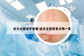 達力士根治牛皮癬 達力士軟膏多少錢一支
