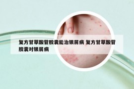 復(fù)方甘草酸苷膠囊能治銀屑病 復(fù)方甘草酸苷膠囊對(duì)銀屑病