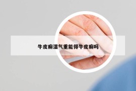 牛皮癬濕氣重能得牛皮癬嗎