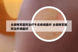 全國哪家醫(yī)院治療牛皮癬病最好 全國哪家醫(yī)院治肝病最好