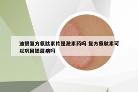 迪銀復(fù)方氨肽素片是激素藥嗎 復(fù)方氨肽素可以鞏固銀屑病嗎