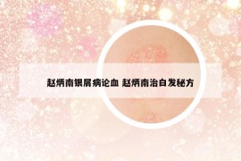 趙炳南銀屑病論血 趙炳南治白發(fā)秘方