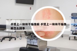 手臂上一塊塊干燥像癬 手臂上一塊塊干燥像癬怎么回事