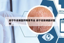 南寧牛皮癬醫(yī)院哪里專業(yè) 南寧皮膚病最好醫(yī)院