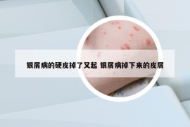 銀屑病的硬皮掉了又起 銀屑病掉下來的皮屑