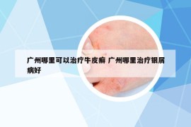 廣州哪里可以治療牛皮癬 廣州哪里治療銀屑病好