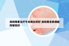 南陽哪里治療牛皮癬比較好 南陽看皮膚病醫(yī)院哪家好
