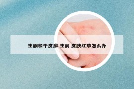 生酮和牛皮癬 生酮 皮膚紅疹怎么辦