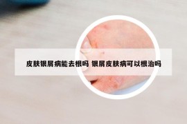 皮膚銀屑病能去根嗎 銀屑皮膚病可以根治嗎
