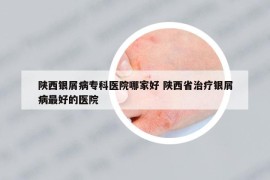 陜西銀屑病?？漆t(yī)院哪家好 陜西省治療銀屑病最好的醫(yī)院