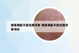 銀屑病能不能吃西洋參 銀屑病能不能吃西洋參泡水