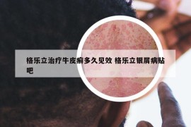 格樂立治療牛皮癬多久見效 格樂立銀屑病貼吧
