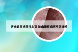 濟南銀屑病醫(yī)院主頁 濟南銀屑病醫(yī)院正規(guī)嗎