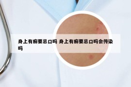 身上有癬要忌口嗎 身上有癬要忌口嗎會傳染嗎