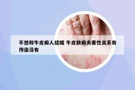不想和牛皮癬人結(jié)婚 牛皮膚癬夫妻性關(guān)系有傳染沒有