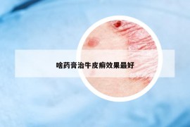 啥藥膏治牛皮癬效果最好