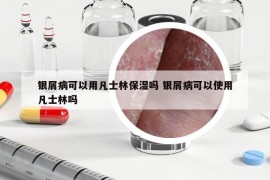 銀屑病可以用凡士林保濕嗎 銀屑病可以使用凡士林嗎
