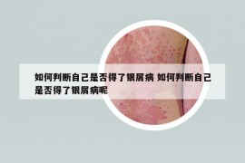 如何判斷自己是否得了銀屑病 如何判斷自己是否得了銀屑病呢