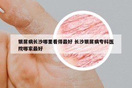 銀屑病長(zhǎng)沙哪里看得最好 長(zhǎng)沙銀屑病專(zhuān)科醫(yī)院哪家最好