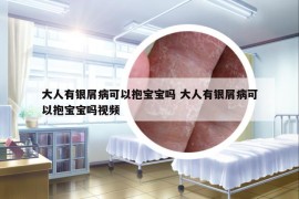 大人有銀屑病可以抱寶寶嗎 大人有銀屑病可以抱寶寶嗎視頻