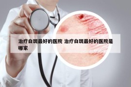 治療白斑最好的醫(yī)院 治療白斑最好的醫(yī)院是哪家