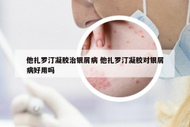 他扎羅汀凝膠治銀屑病 他扎羅汀凝膠對銀屑病好用嗎