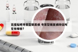 百度貼吧尋常型銀屑病 尋常型銀屑病特征所見有哪些?