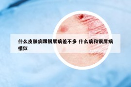 什么皮膚病跟銀屑病差不多 什么病和銀屑病相似