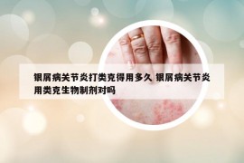 銀屑病關(guān)節(jié)炎打類克得用多久 銀屑病關(guān)節(jié)炎用類克生物制劑對嗎
