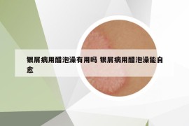 銀屑病用醋泡澡有用嗎 銀屑病用醋泡澡能自愈