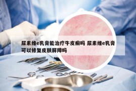 尿素維e乳膏能治療牛皮癬嗎 尿素維e乳膏可以修復(fù)皮膚屏障嗎