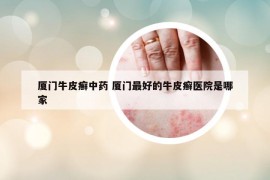 廈門牛皮癬中藥 廈門最好的牛皮癬醫(yī)院是哪家