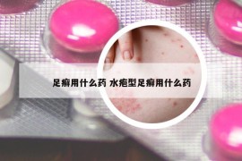 足癬用什么藥 水皰型足癬用什么藥
