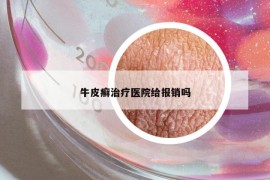 牛皮癬治療醫(yī)院給報銷嗎