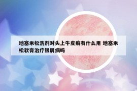 地塞米松洗劑對頭上牛皮癬有什么用 地塞米松軟膏治療銀屑病嗎