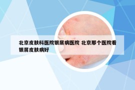 北京皮膚科醫(yī)院銀屑病醫(yī)院 北京那個醫(yī)院看銀屑皮膚病好