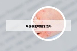牛皮癬能喝糯米酒嗎