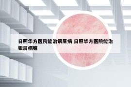 日照華方醫(yī)院能治銀屑病 日照華方醫(yī)院能治銀屑病嘛