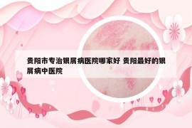 貴陽(yáng)市專治銀屑病醫(yī)院哪家好 貴陽(yáng)最好的銀屑病中醫(yī)院