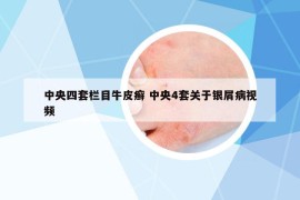 中央四套欄目牛皮癬 中央4套關(guān)于銀屑病視頻