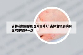 吉林治銀屑病的醫(yī)院哪家好 吉林治銀屑病的醫(yī)院哪家好一點(diǎn)