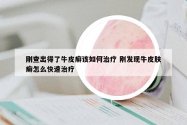 剛查出得了牛皮癬該如何治療 剛發(fā)現(xiàn)牛皮膚癬怎么快速治療