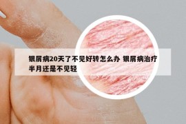 銀屑病20天了不見好轉怎么辦 銀屑病治療半月還是不見輕