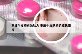 重癥牛皮癬有效驗(yàn)方 重度牛皮膚癬的癥狀圖片