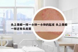 頭上像癬一樣一小塊一小塊的起皮 頭上像癬一樣還有頭皮屑