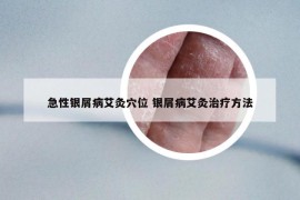 急性銀屑病艾灸穴位 銀屑病艾灸治療方法