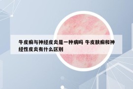 牛皮癬與神經(jīng)皮炎是一種病嗎 牛皮膚癬和神經(jīng)性皮炎有什么區(qū)別