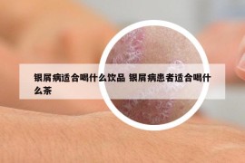 銀屑病適合喝什么飲品 銀屑病患者適合喝什么茶